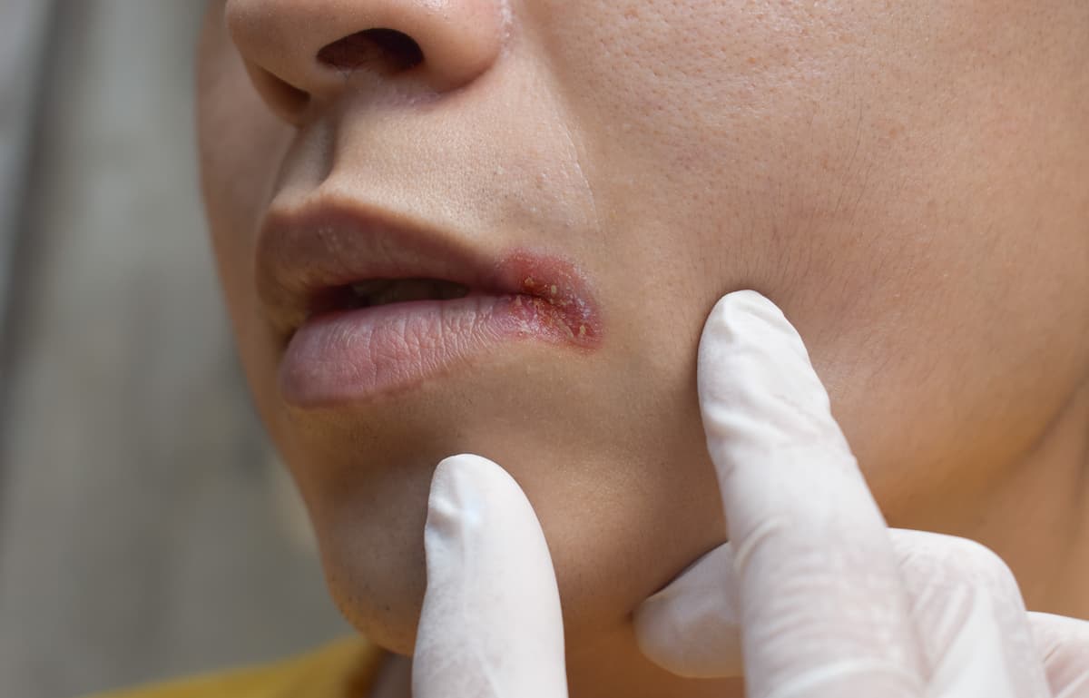 Deficiencia de riboflavina